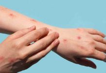 Suspected monkeypox case in Noida